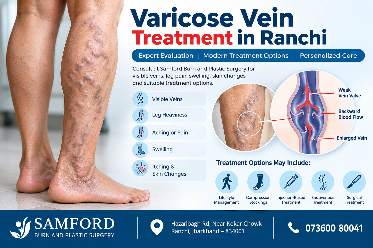 Varicose Vein Treatment in Ranchi